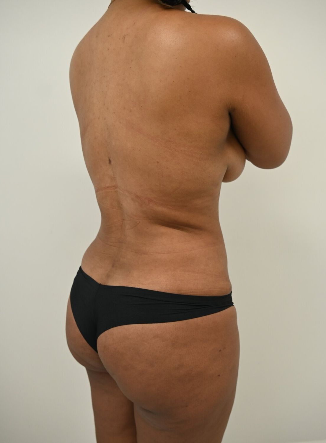 Liposuccion Espalda Before & After