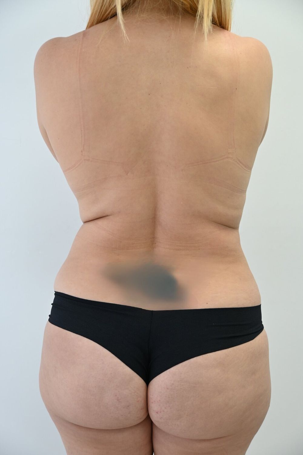 Liposuccion Espalda Before & After