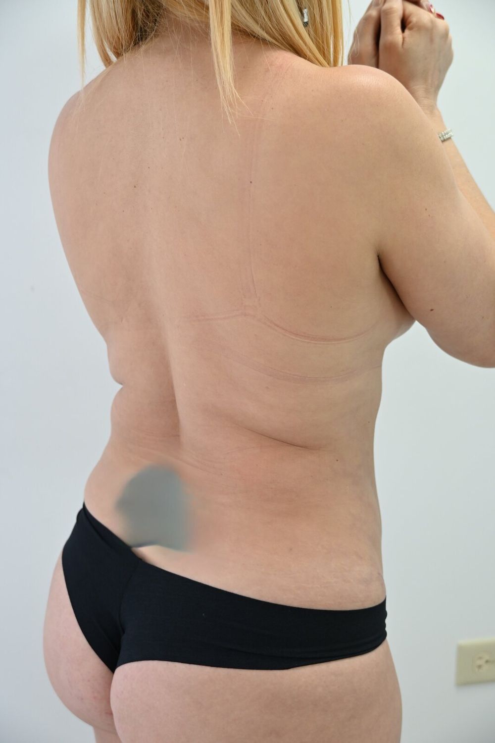 Liposuccion Espalda Before & After