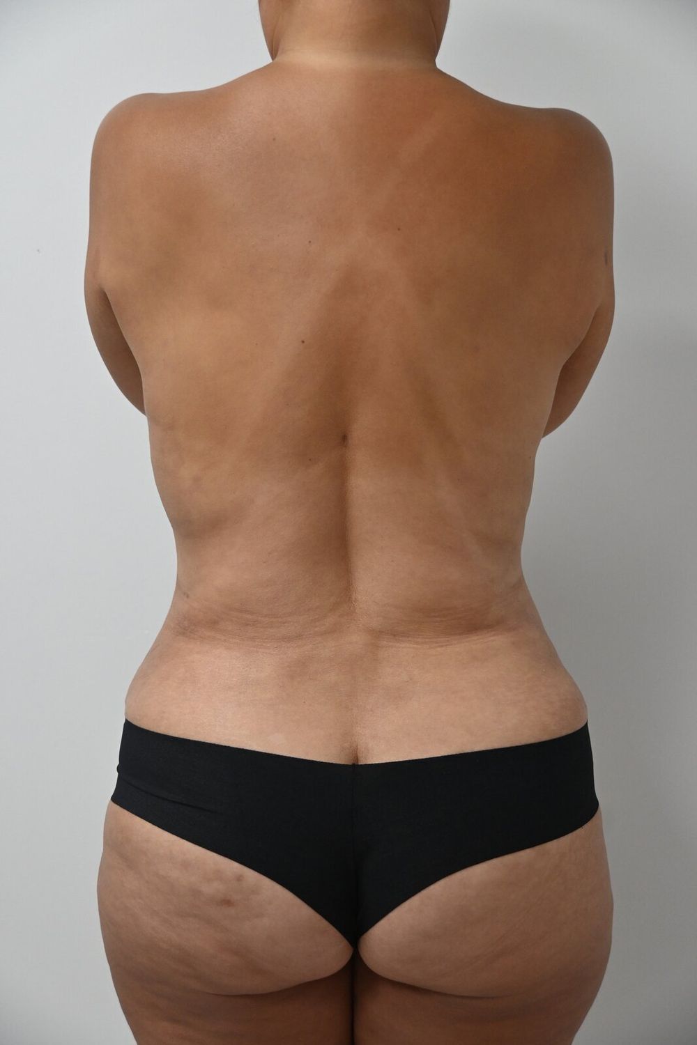 Liposuccion Espalda Before & After