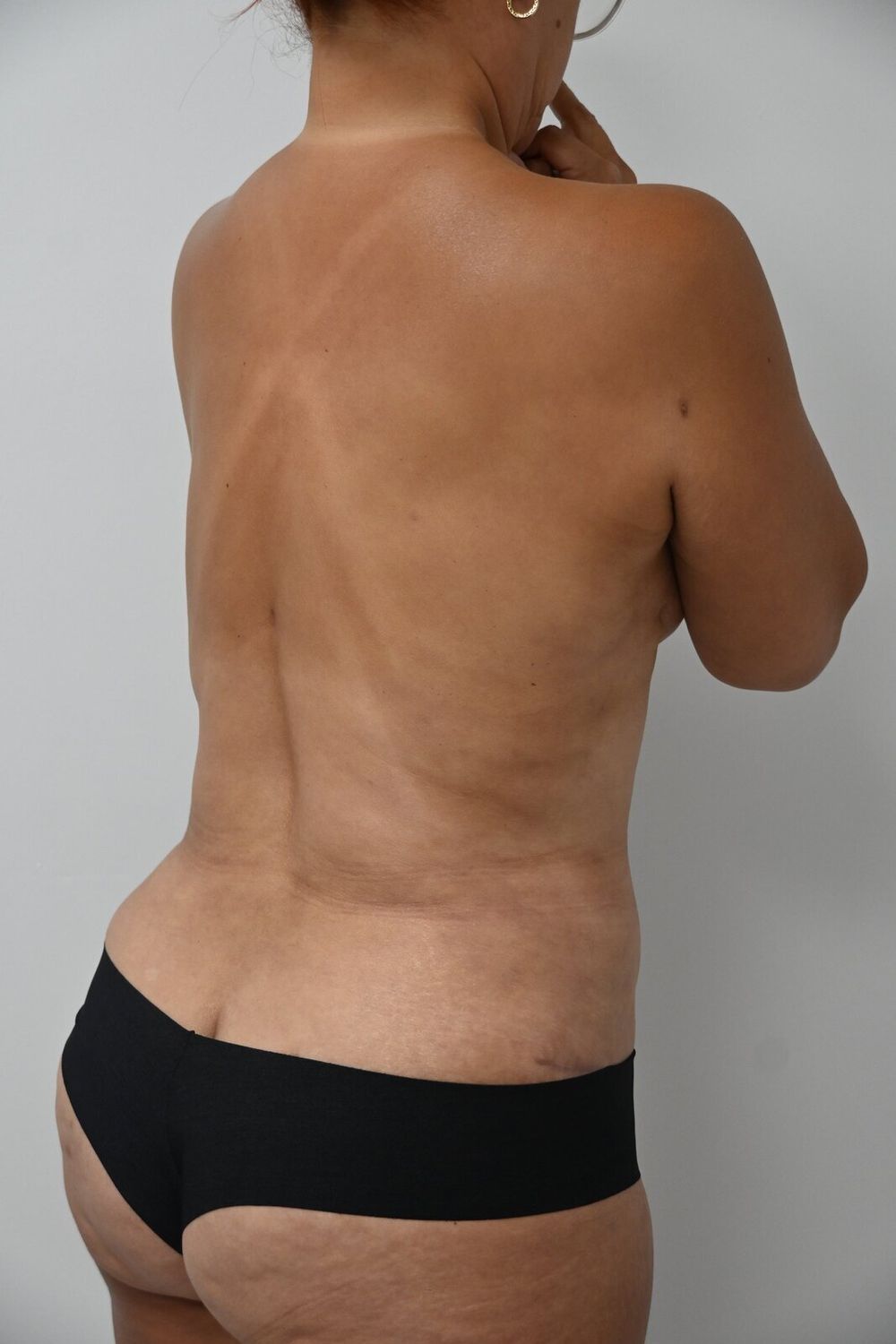 Liposuccion Espalda Before & After