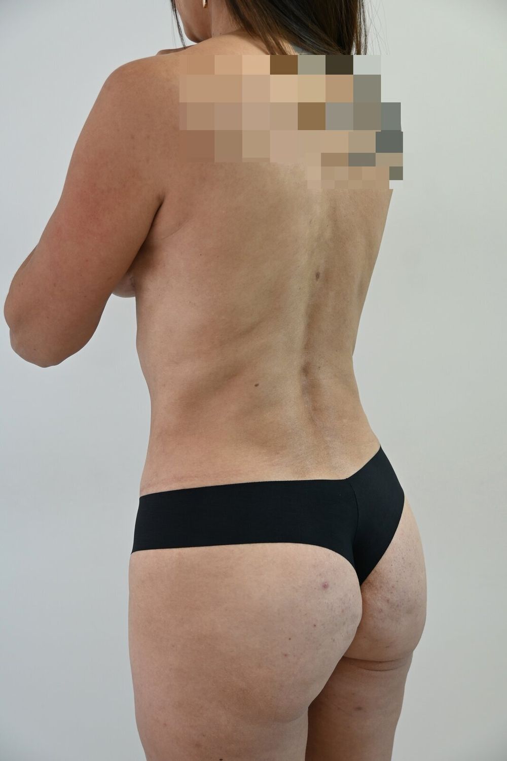 Liposuccion Espalda Before & After