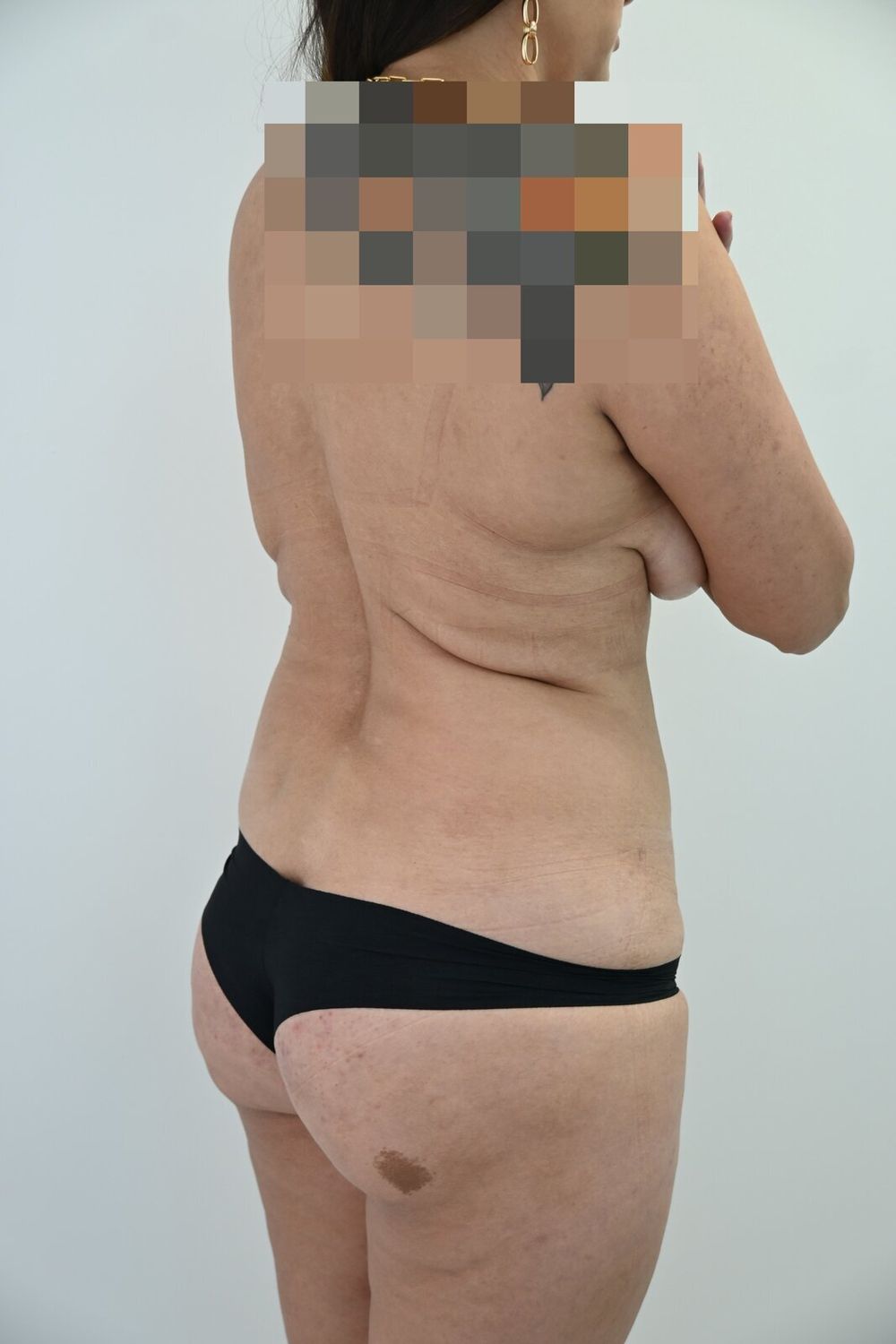 Liposuccion Espalda Before & After