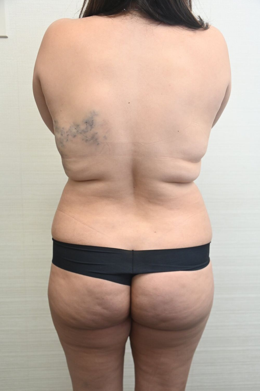 Liposuccion Espalda Before & After