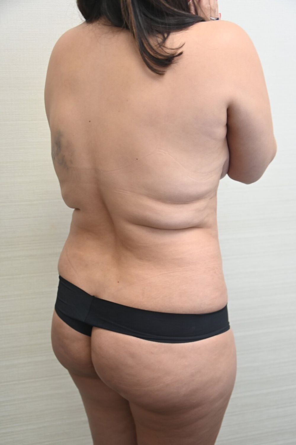 Liposuccion Espalda Before & After