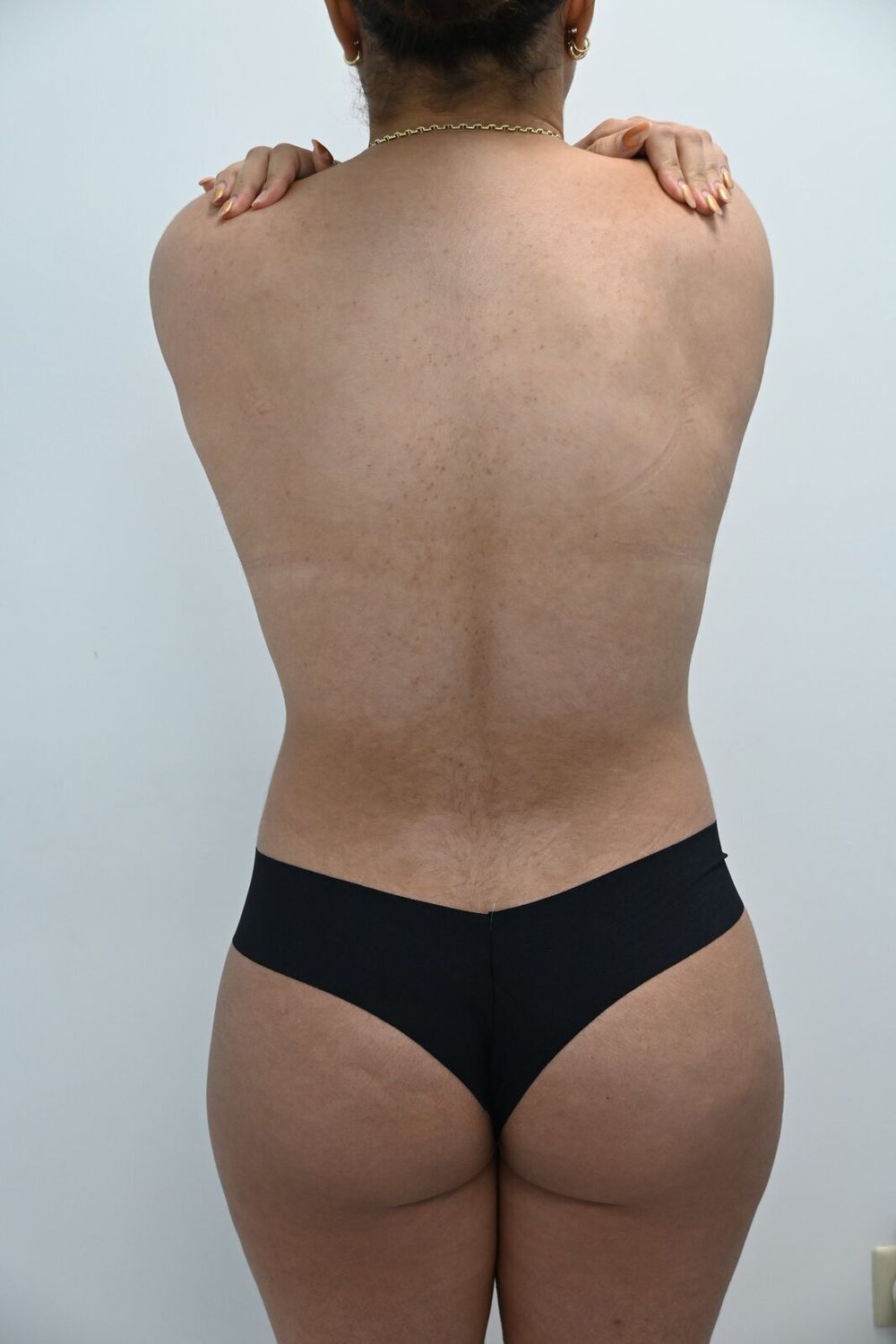 Liposuccion Espalda Before & After