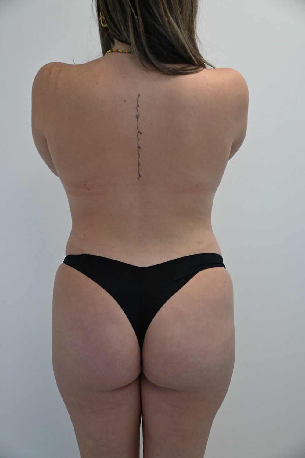 Liposuccion Espalda Before & After