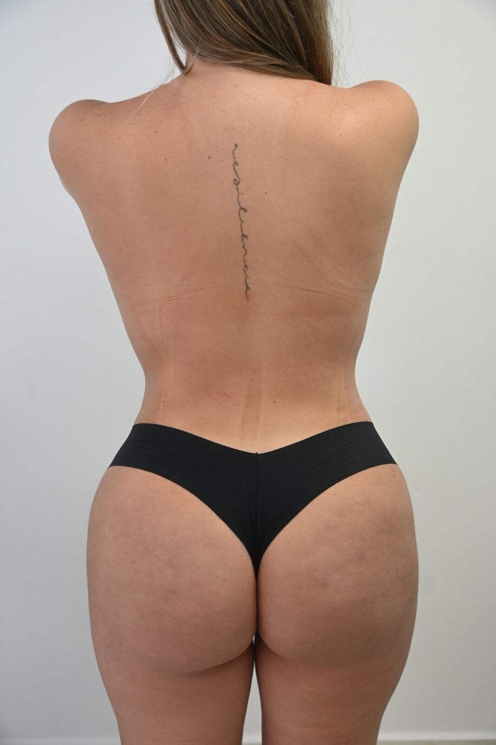 Liposuccion Espalda Before & After