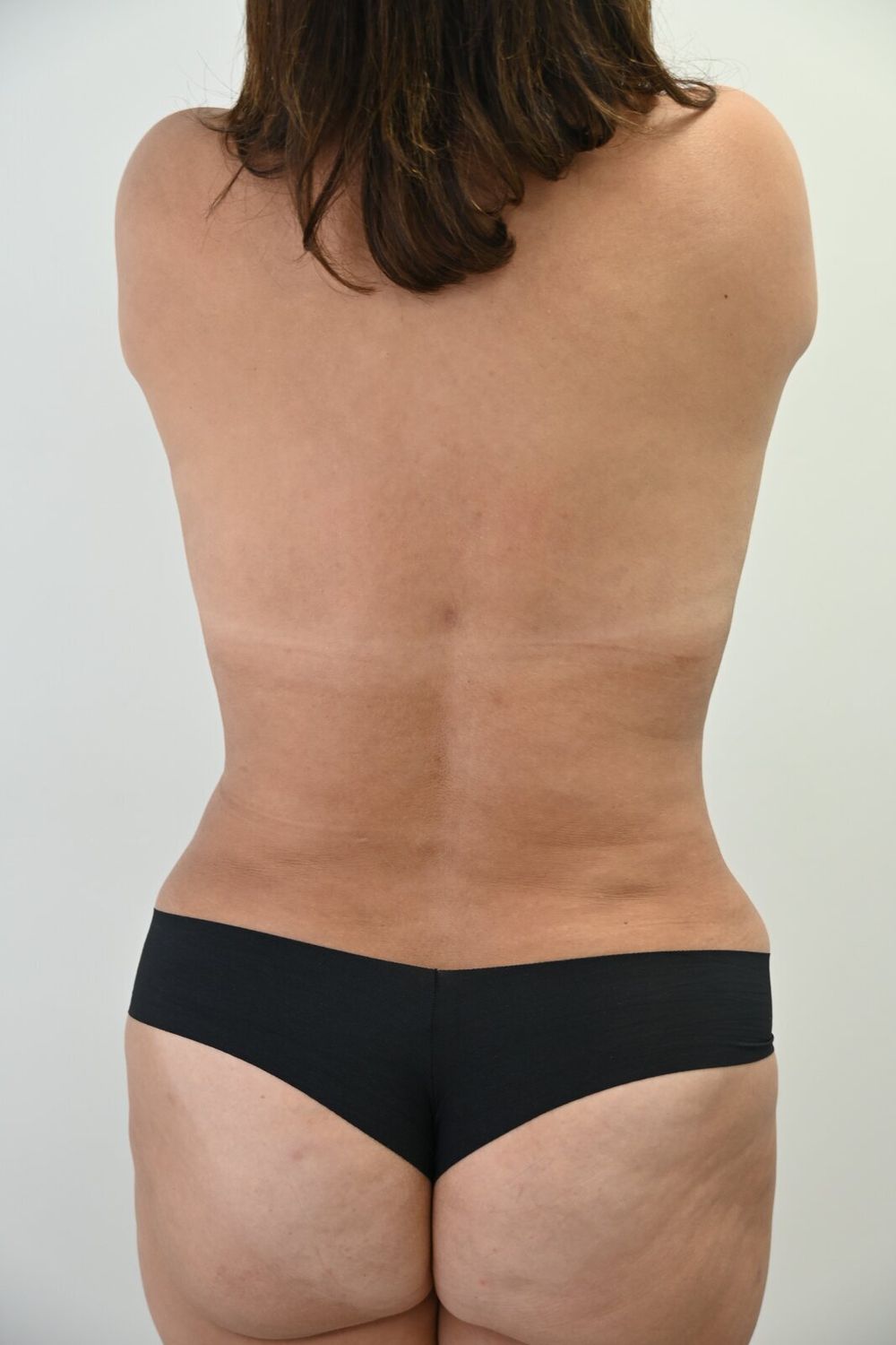 Liposuccion Espalda Before & After