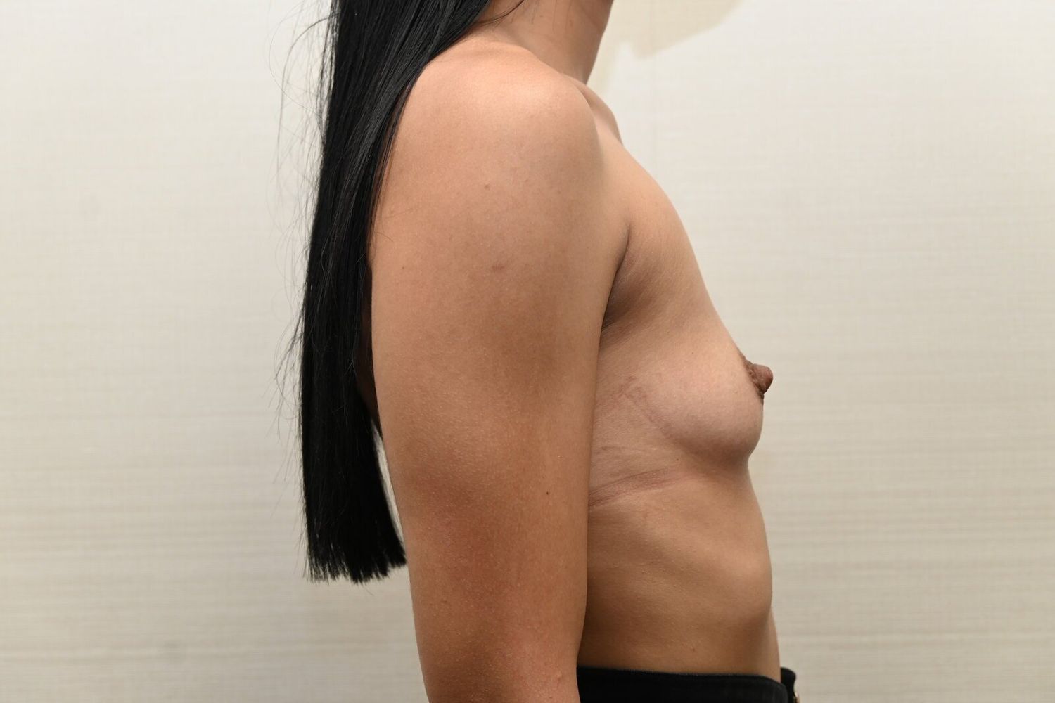 Aumento De Senos Before & After