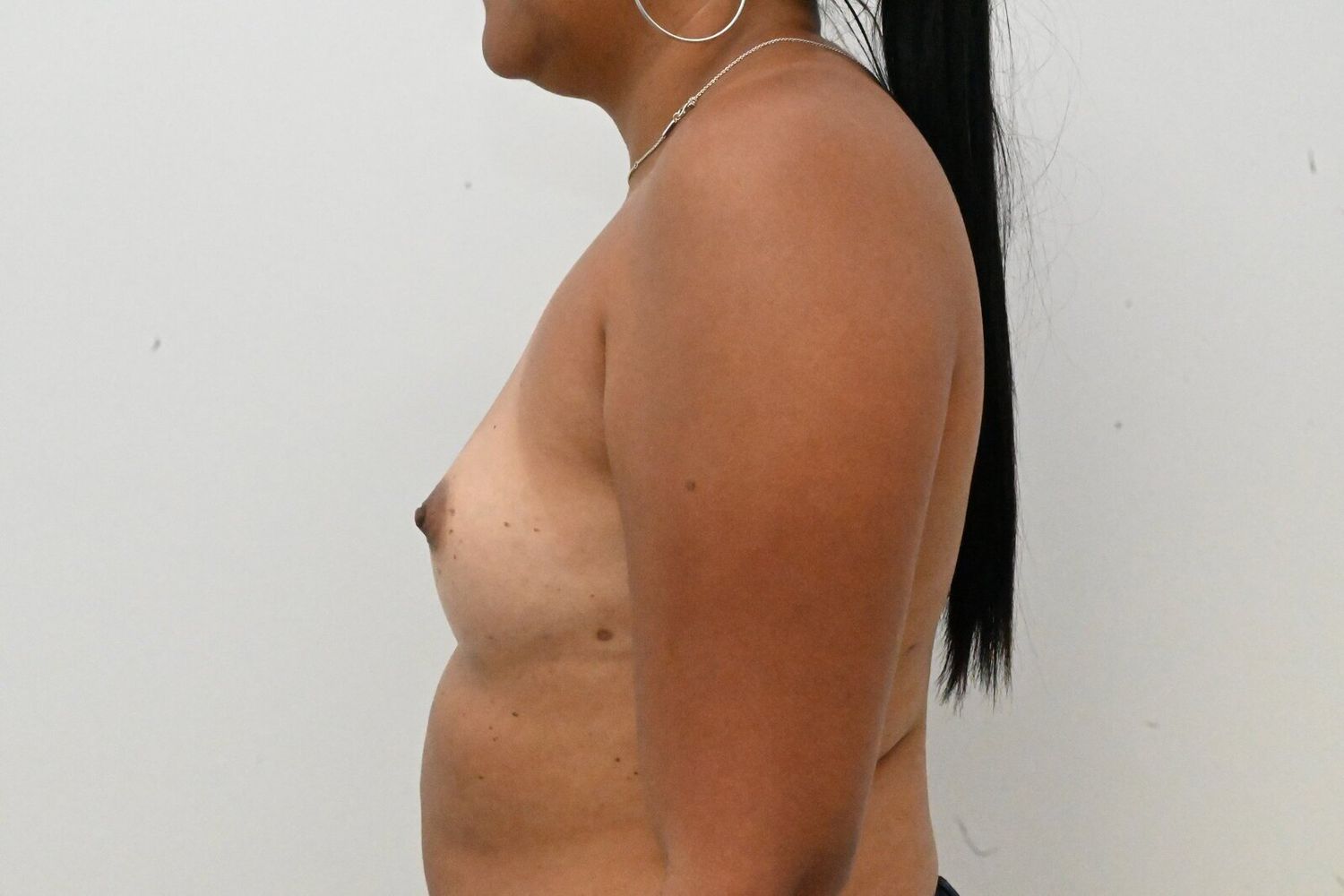 Aumento De Senos Before & After