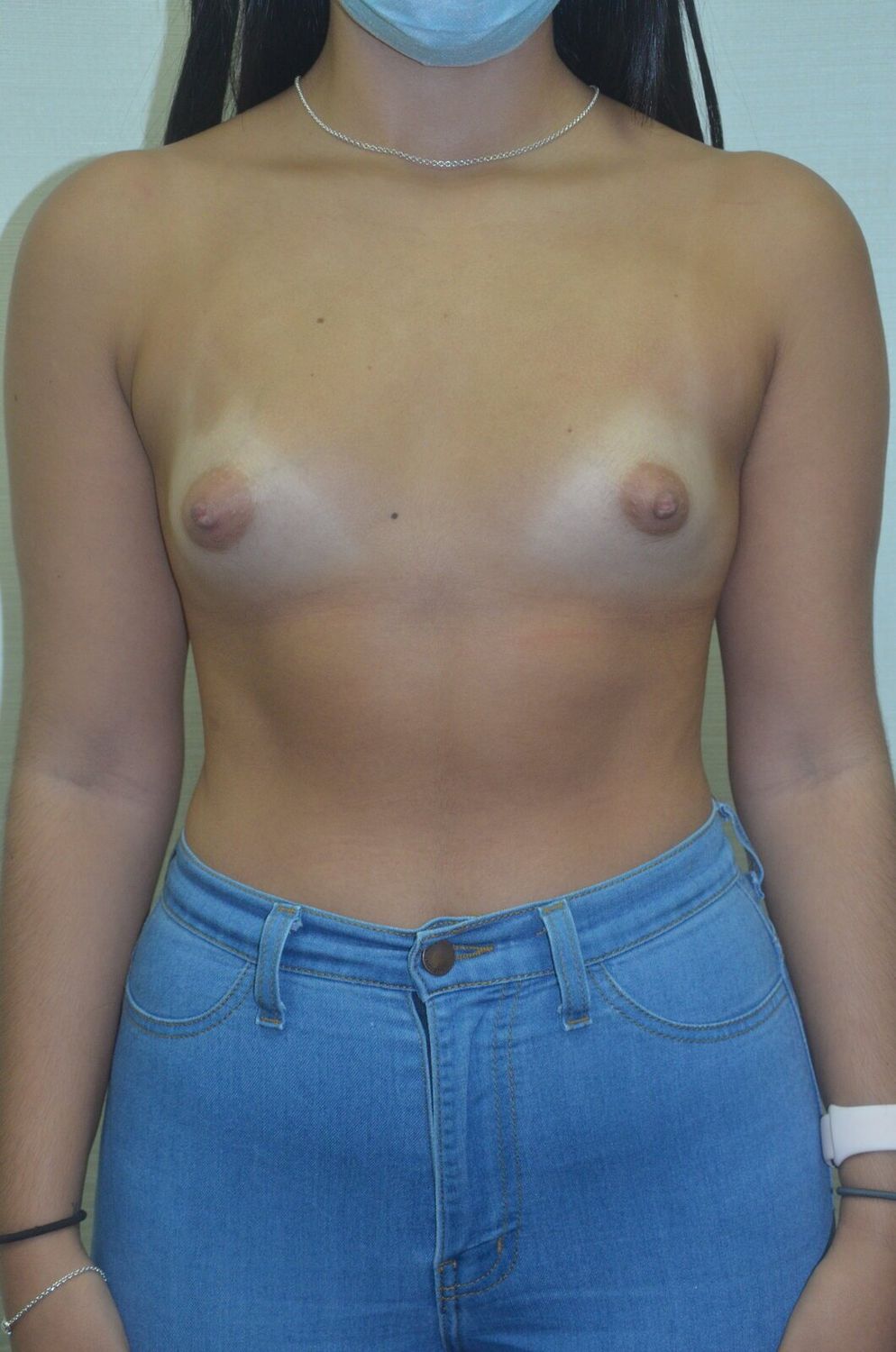 Aumento De Senos Before & After