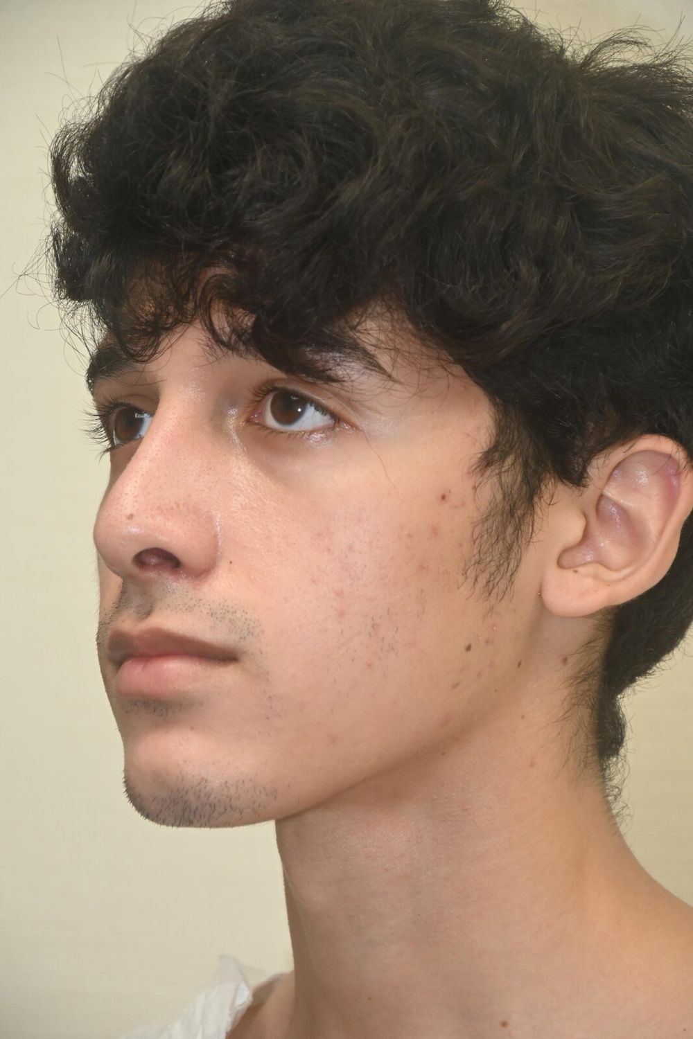 Rinoplastia Before & After