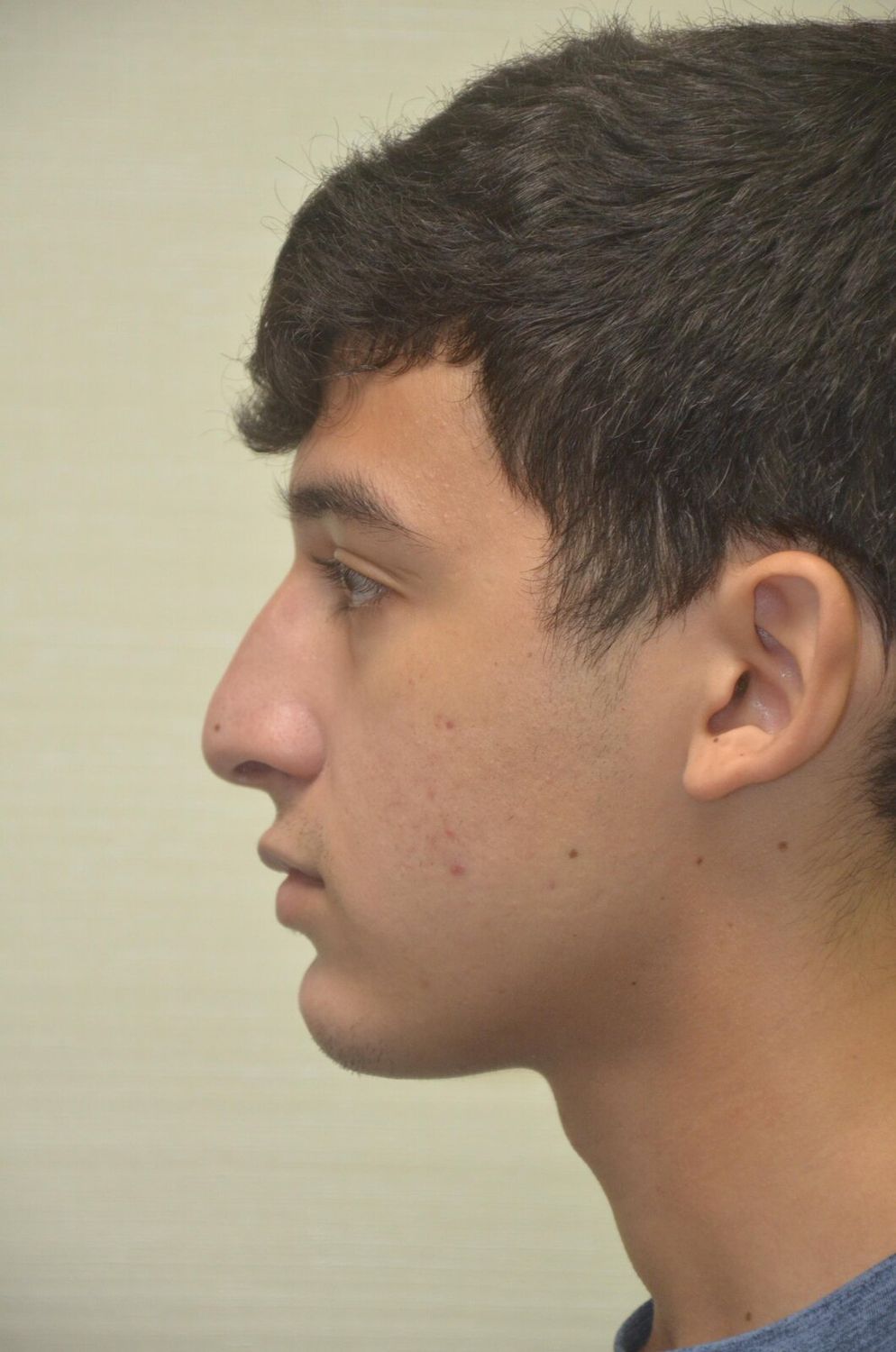 Rinoplastia Before & After