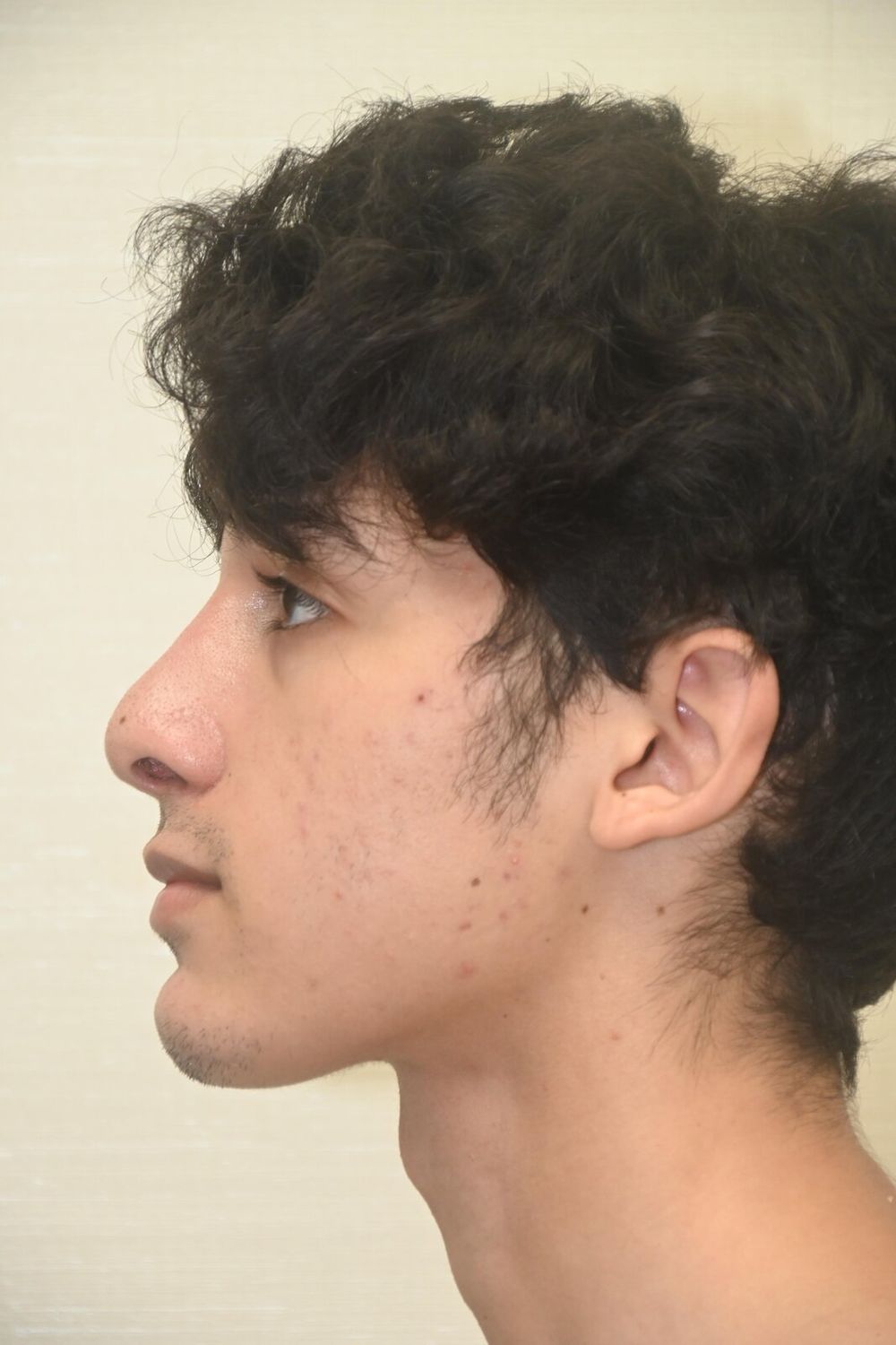 Rinoplastia Before & After