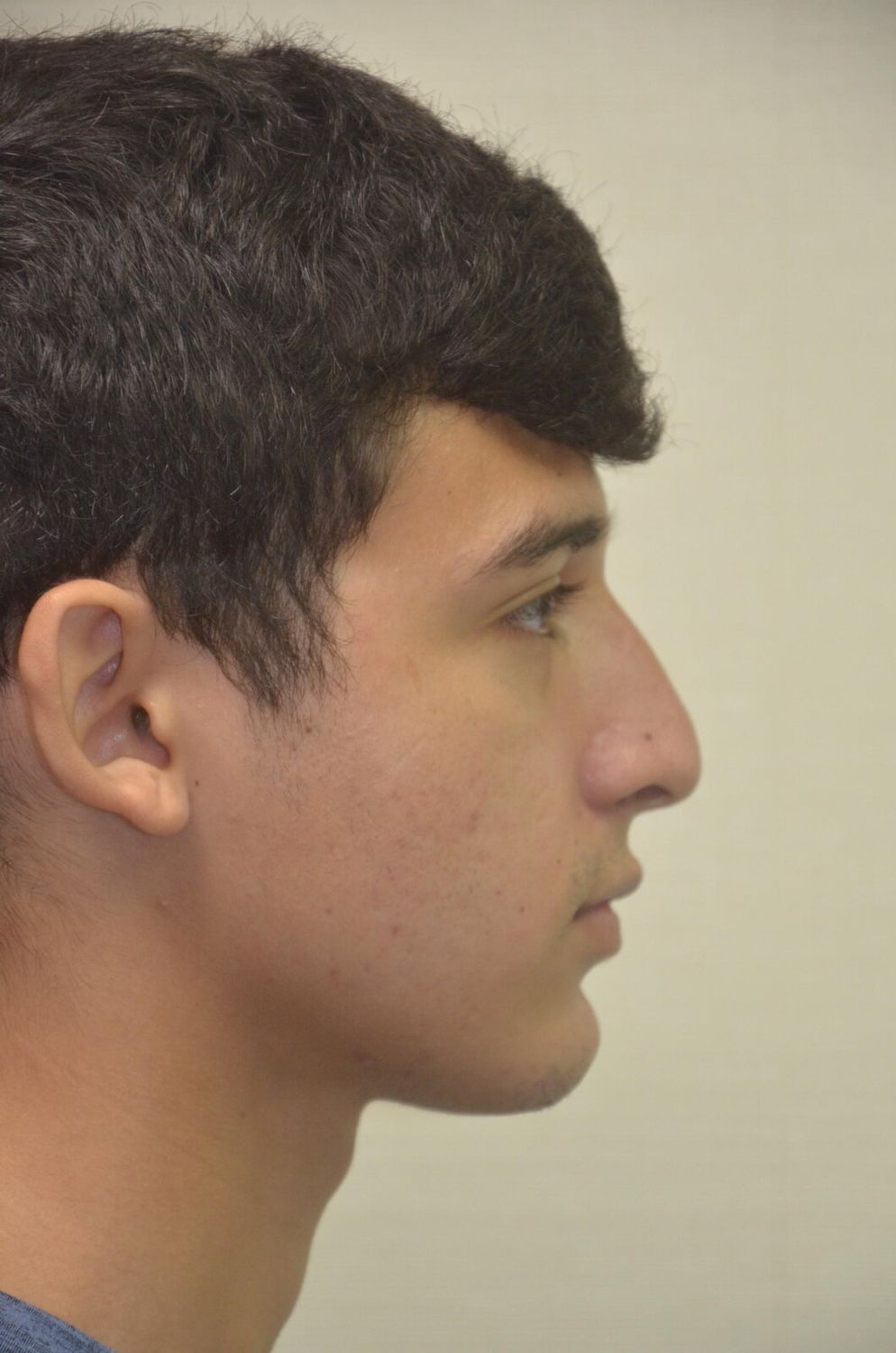 Rinoplastia Before & After