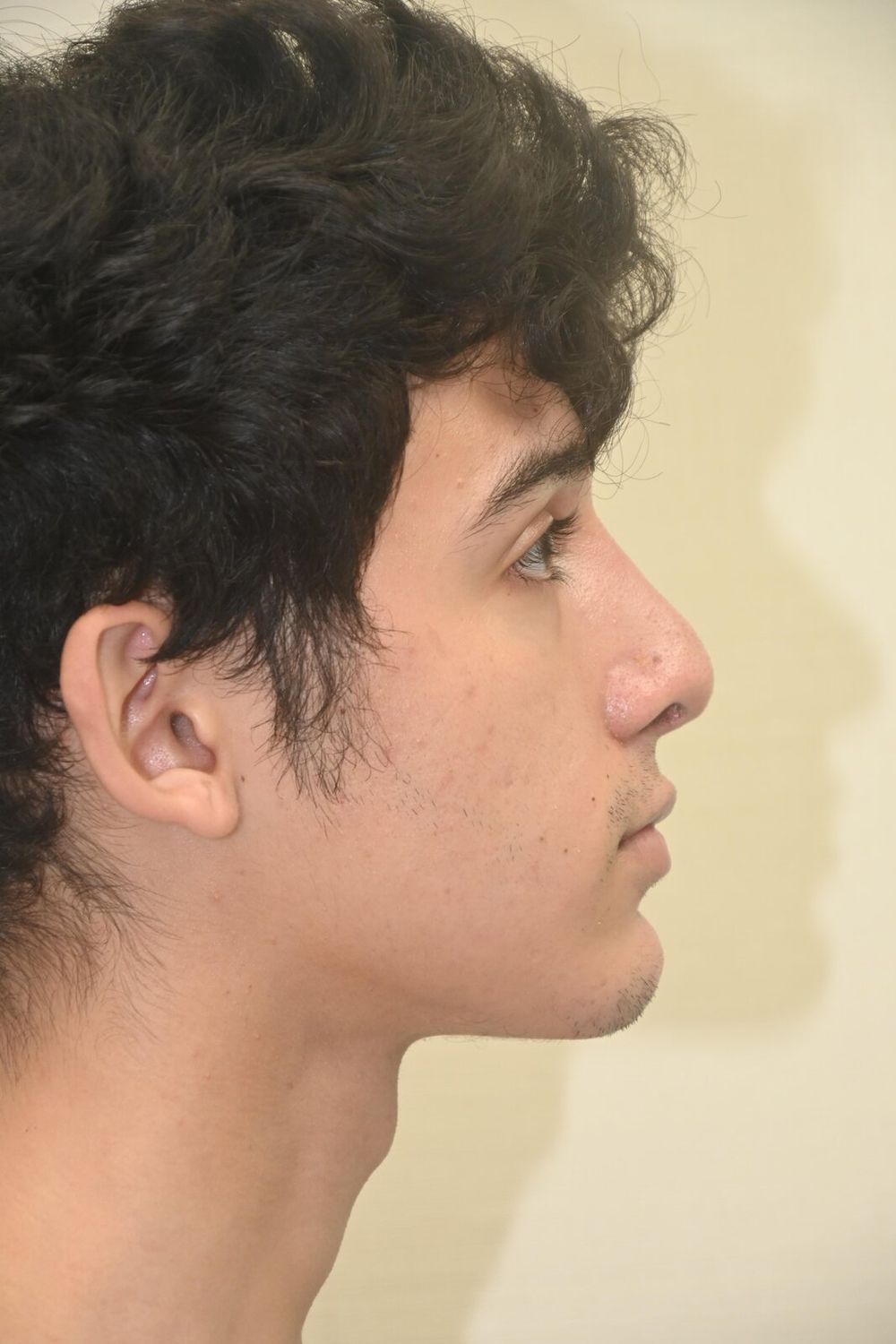 Rinoplastia Before & After