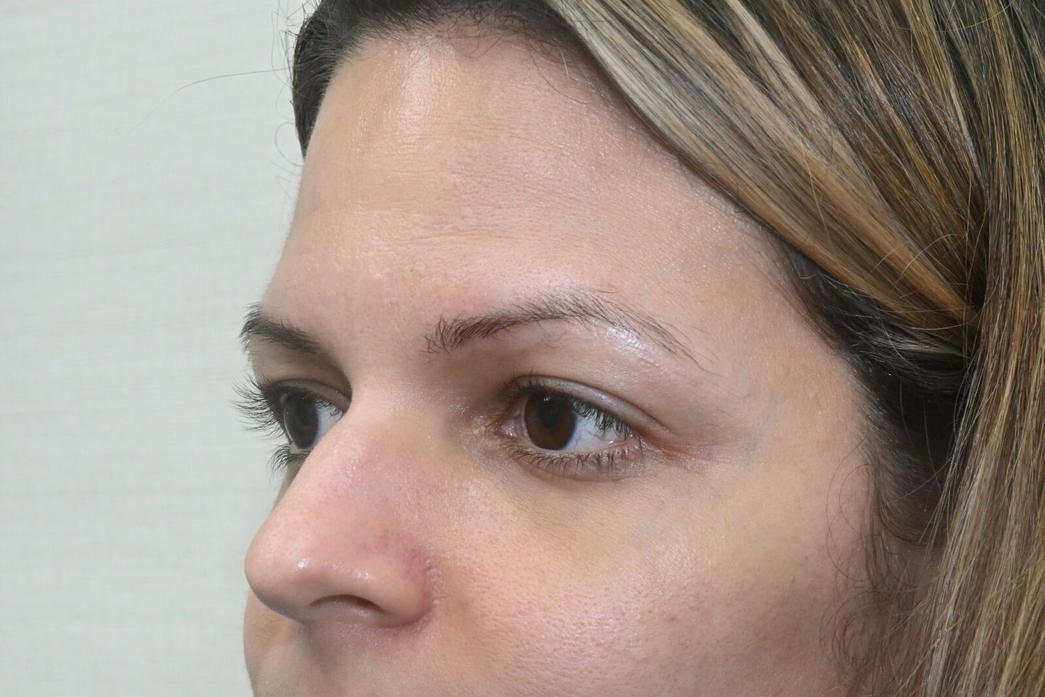 Rinoplastia Before & After