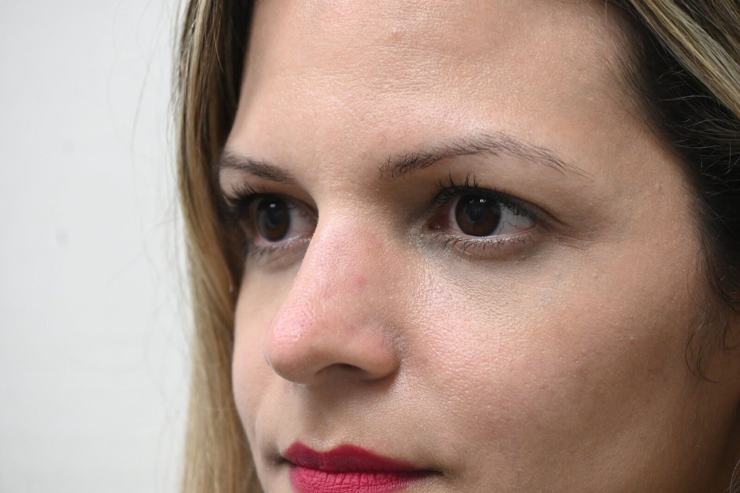 Rinoplastia Before & After