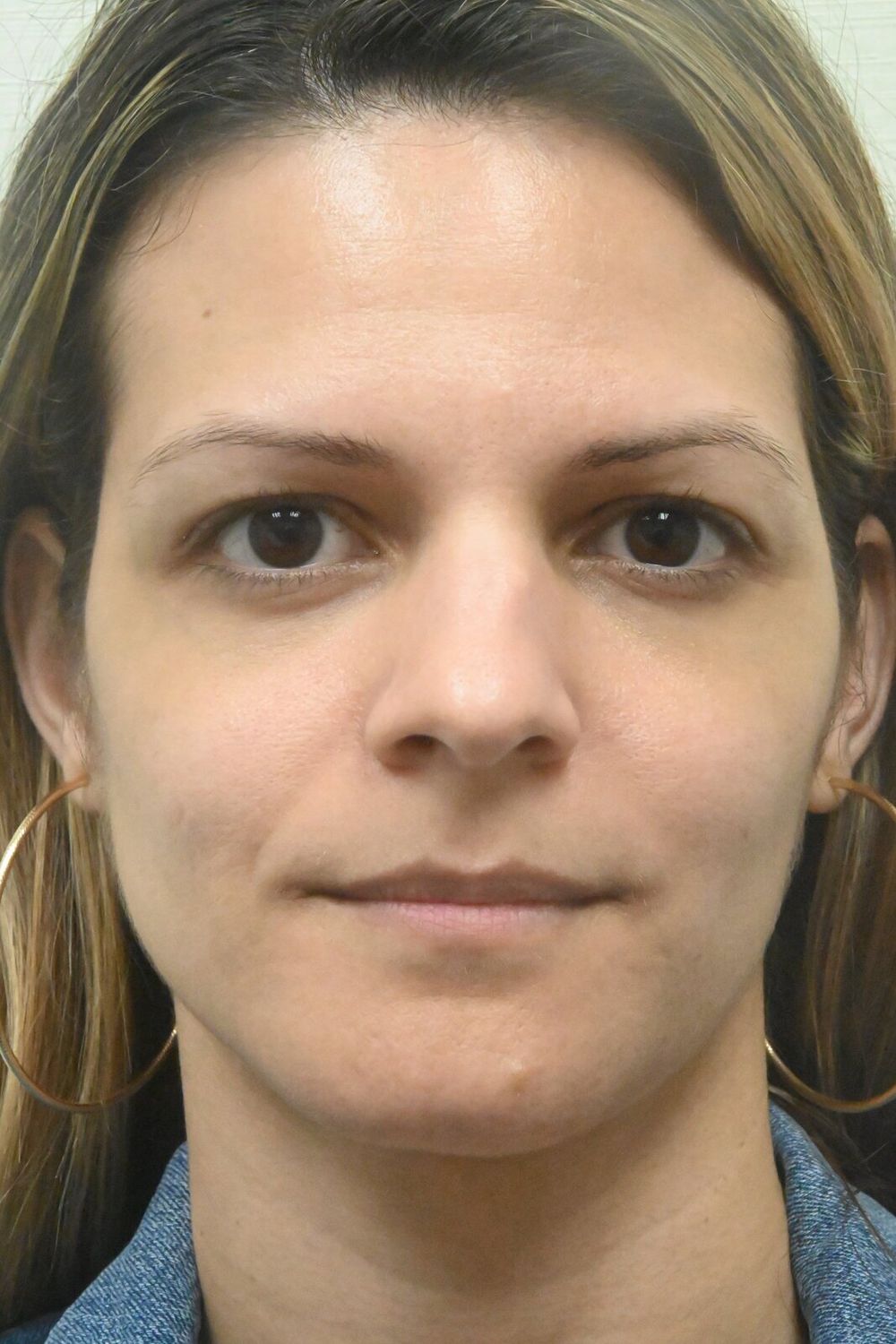 Rinoplastia Before & After