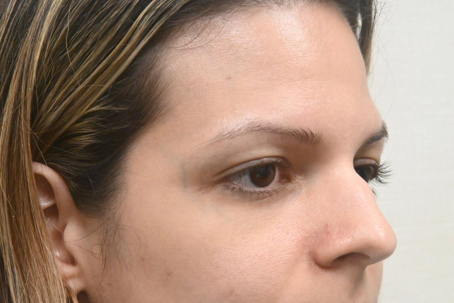 Rinoplastia Before & After