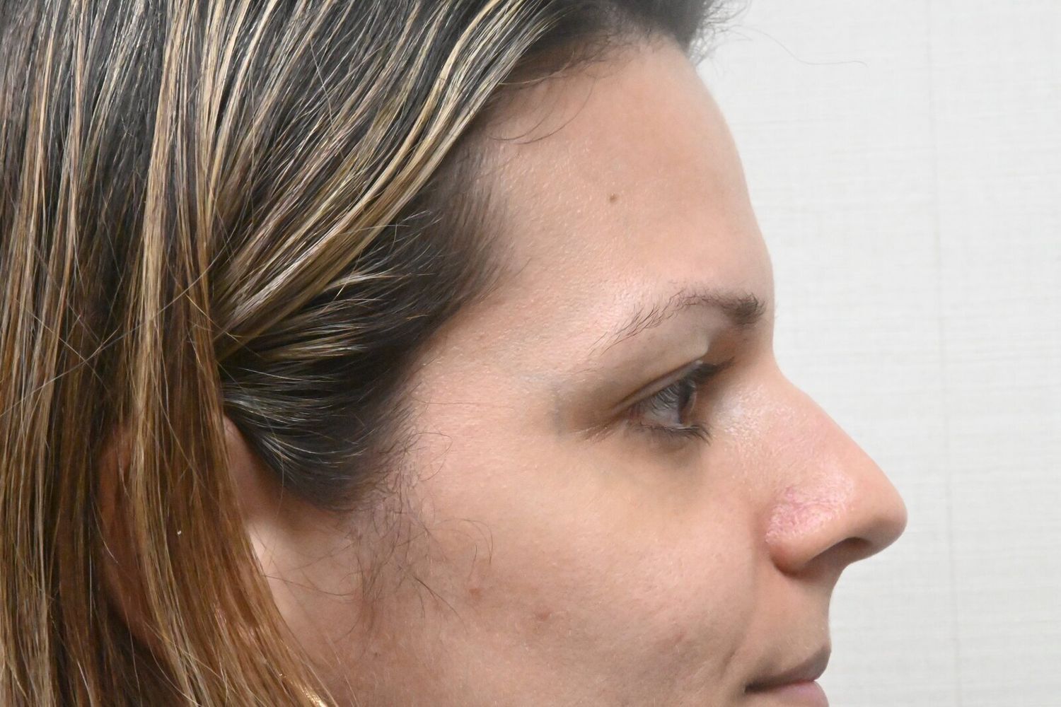 Rinoplastia Before & After