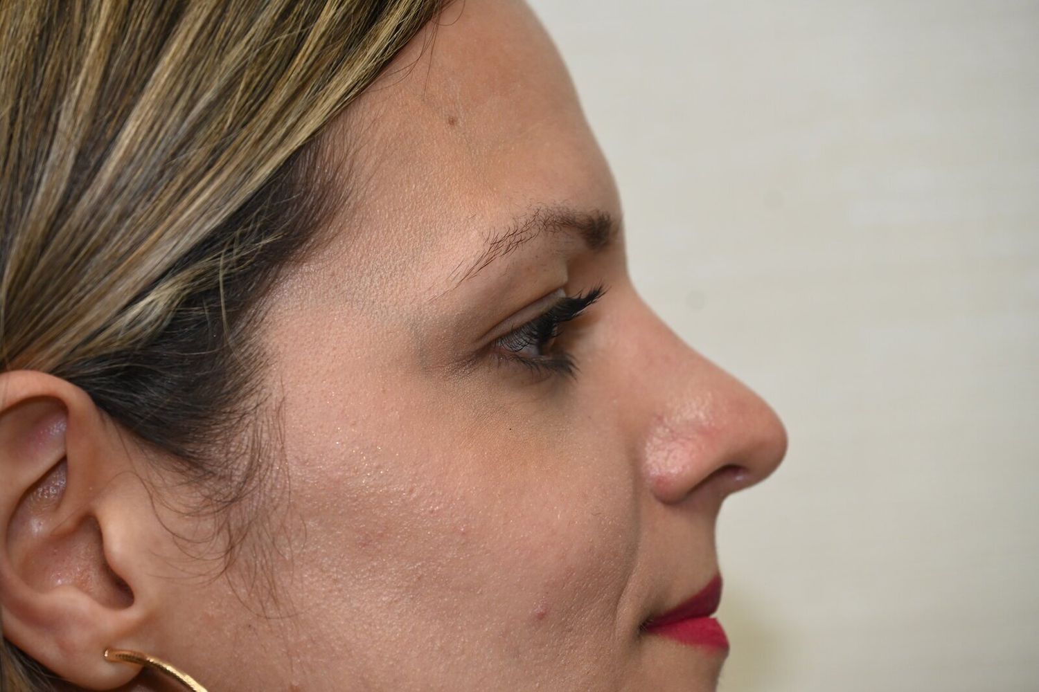 Rinoplastia Before & After