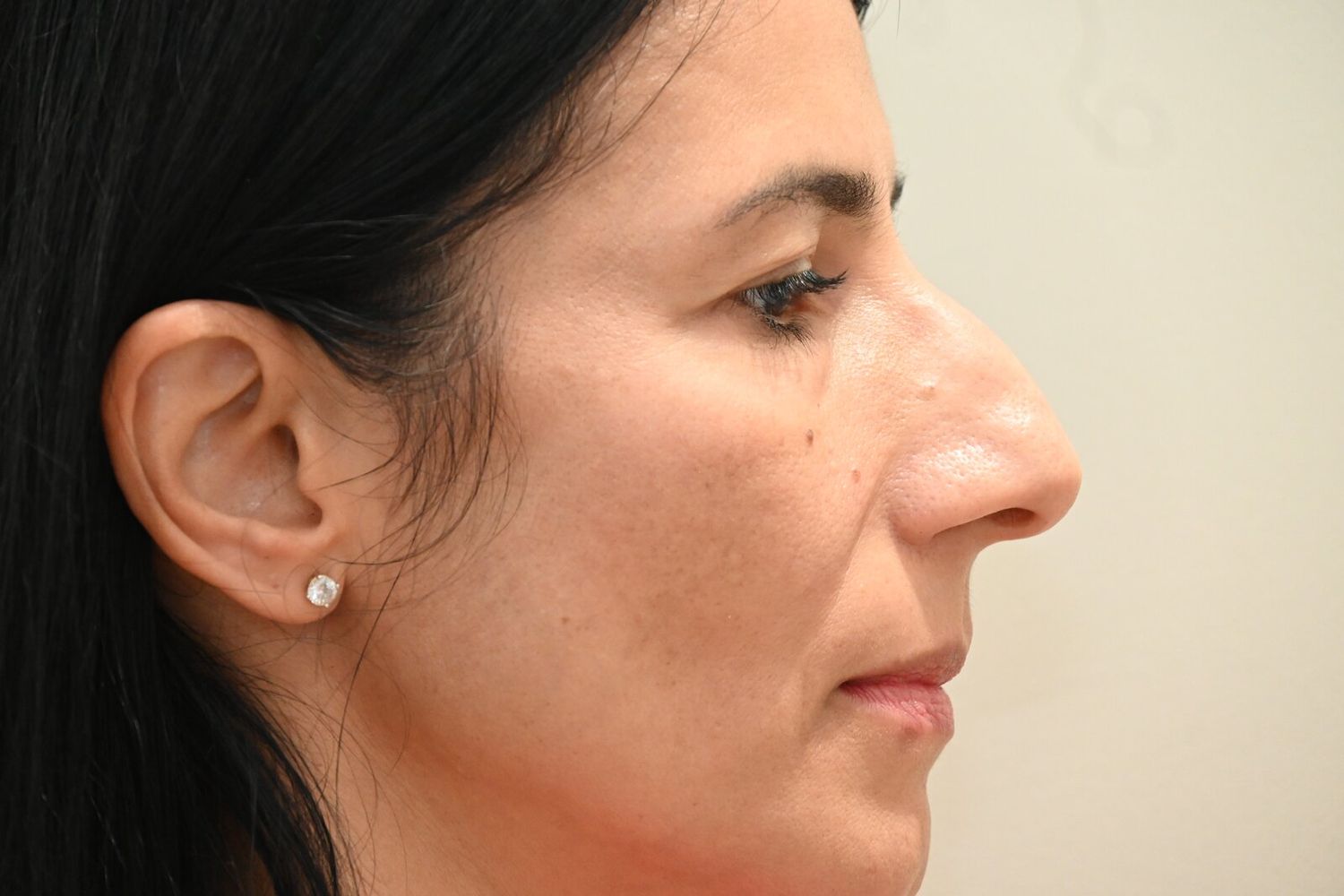 Rinoplastia Before & After