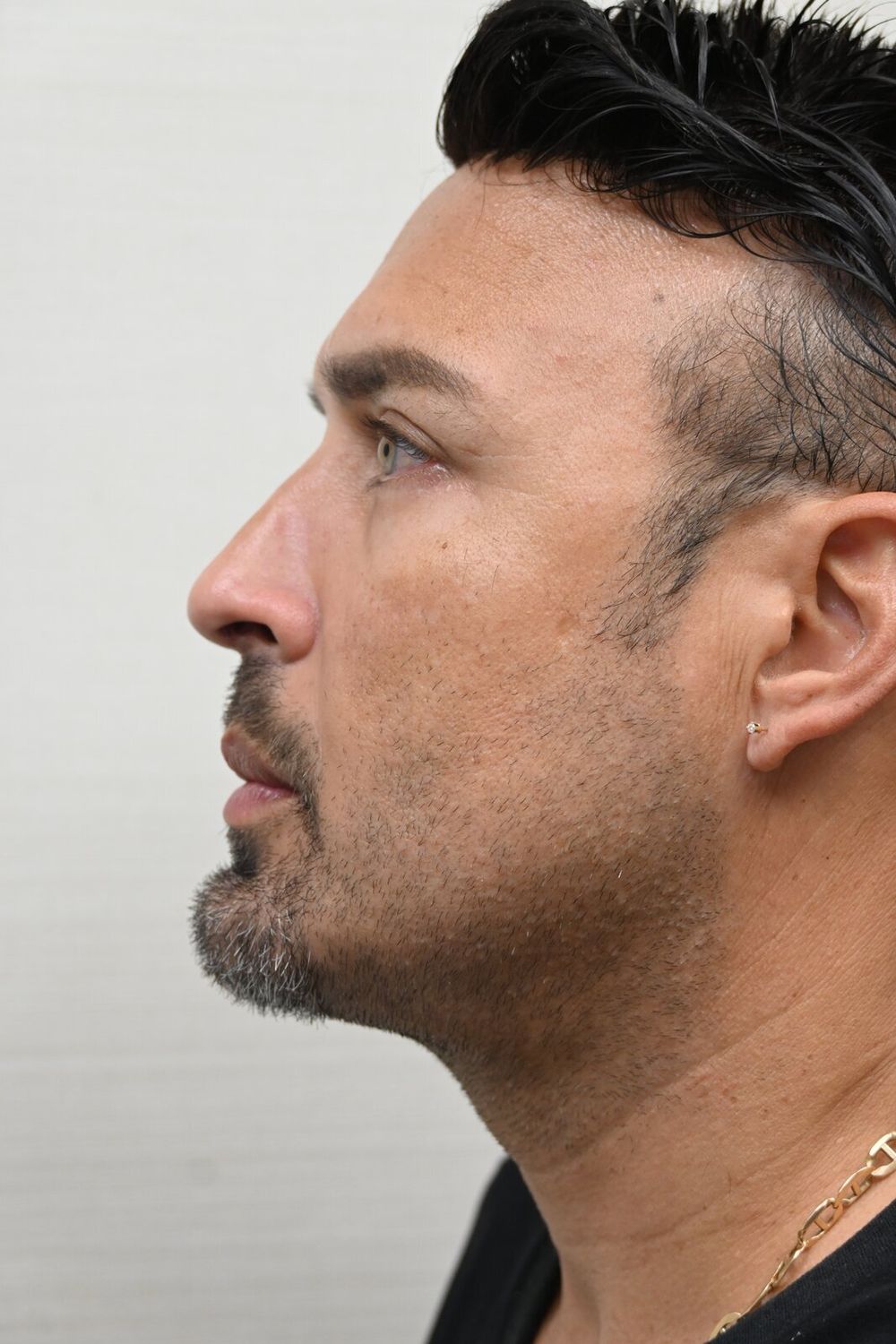 Rinoplastia Before & After