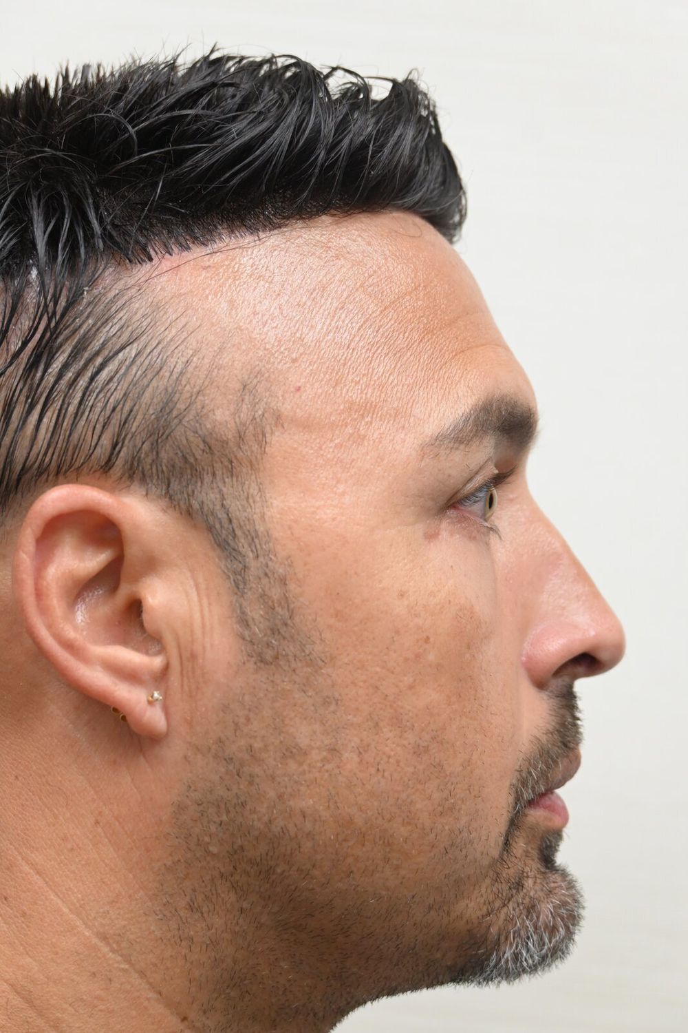 Rinoplastia Before & After