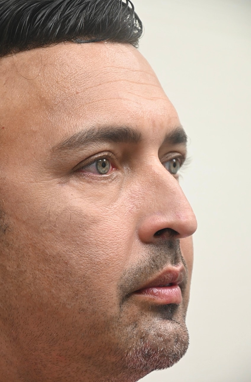 Rinoplastia Before & After