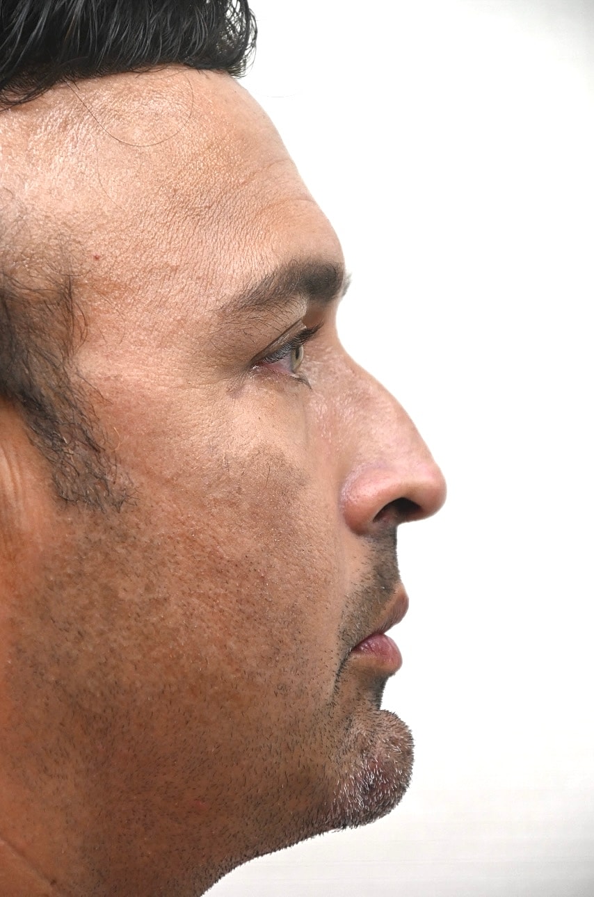 Rinoplastia Before & After