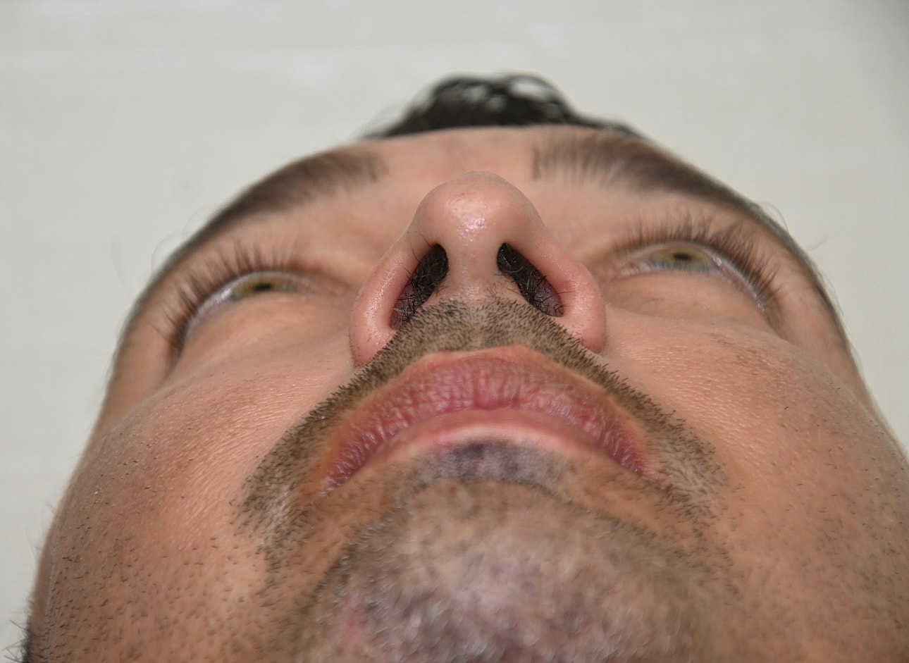 Rinoplastia Before & After