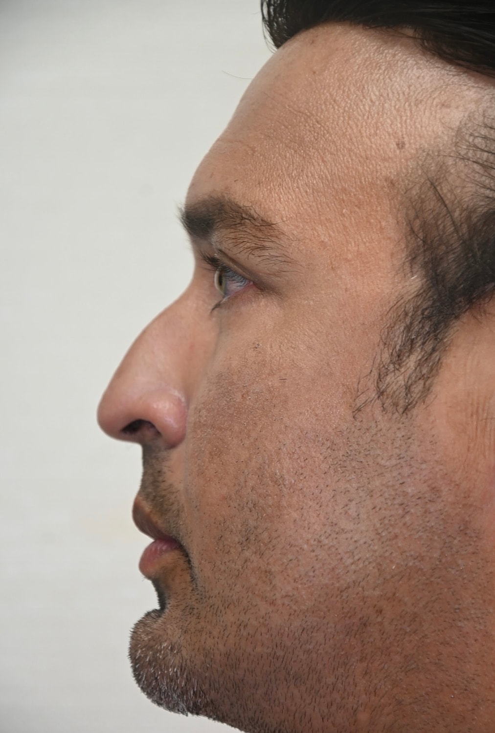 Rinoplastia Before & After