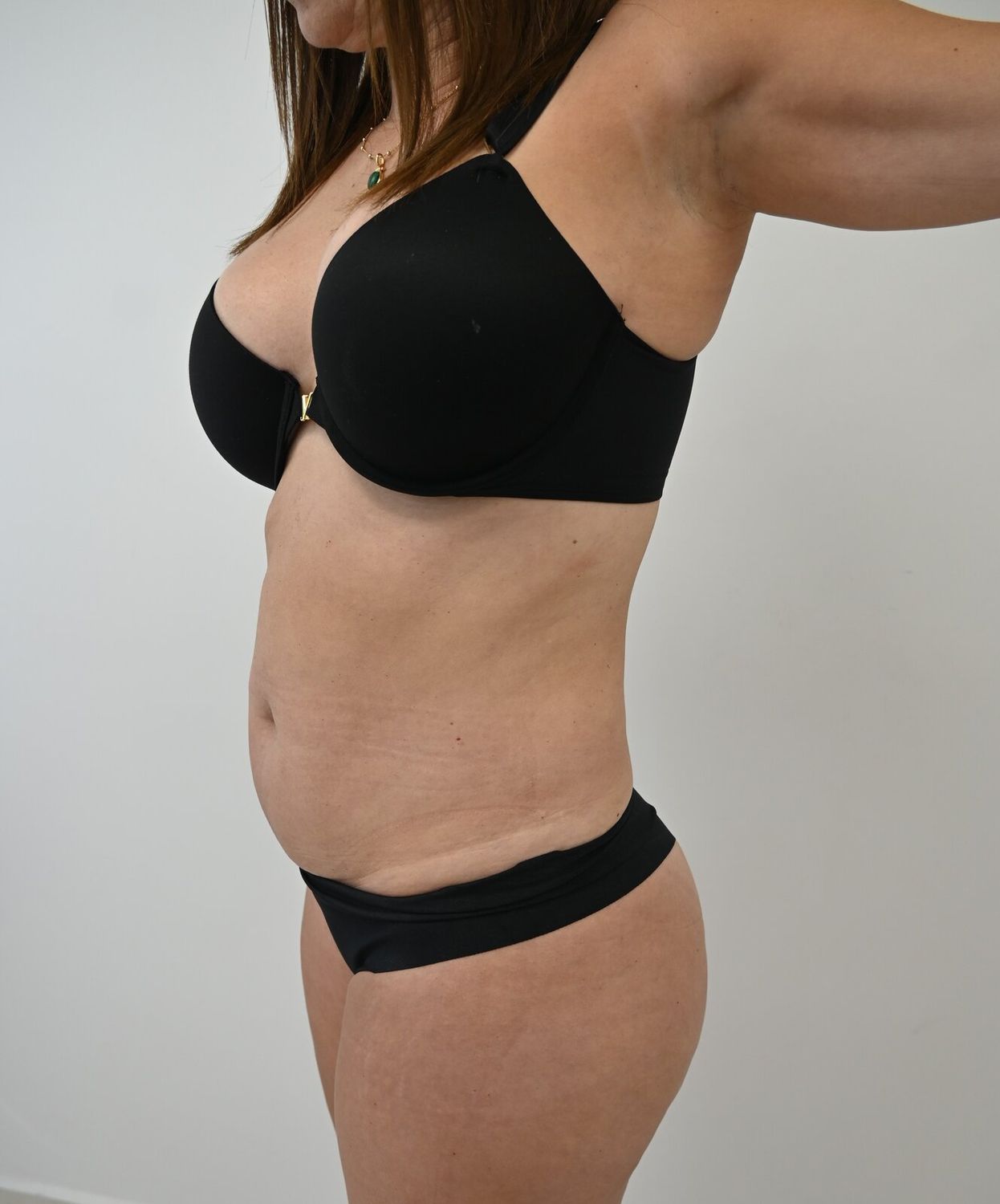 Liposuccion Abdomen Before & After