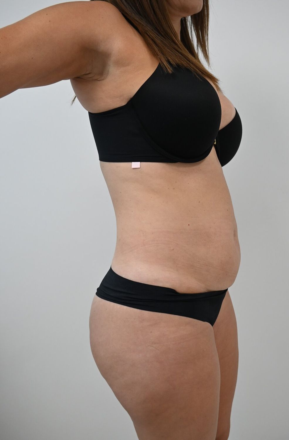 Liposuccion Abdomen Before & After