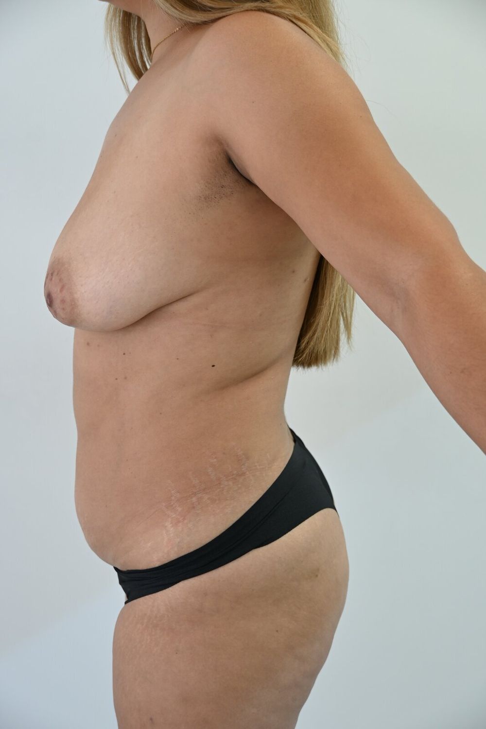 Liposuccion Abdomen Before & After