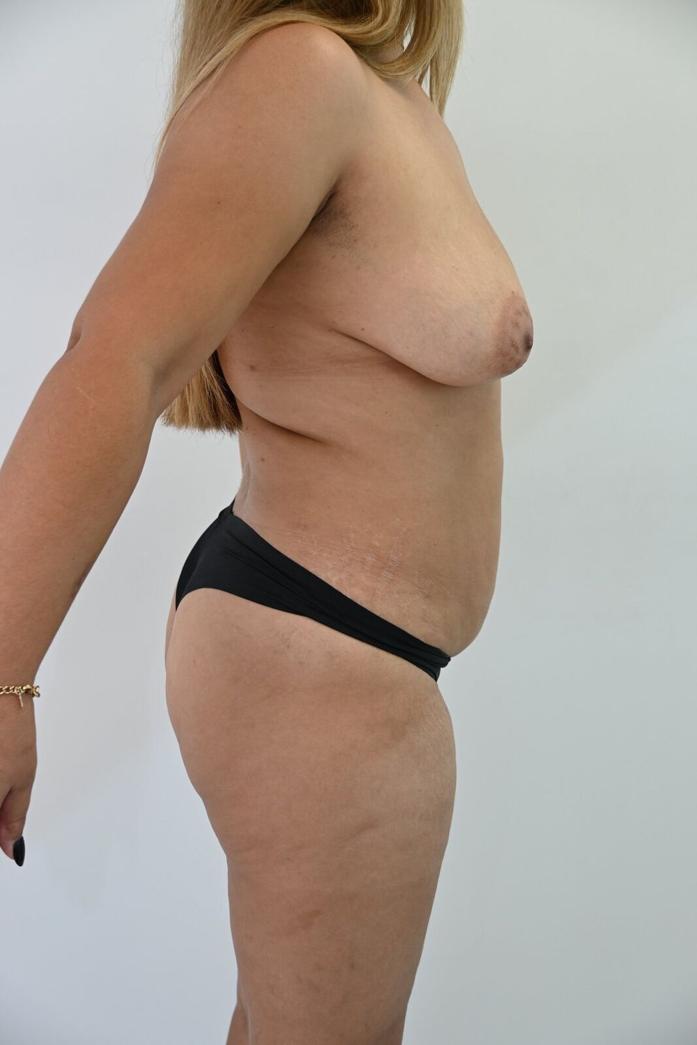 Liposuccion Abdomen Before & After