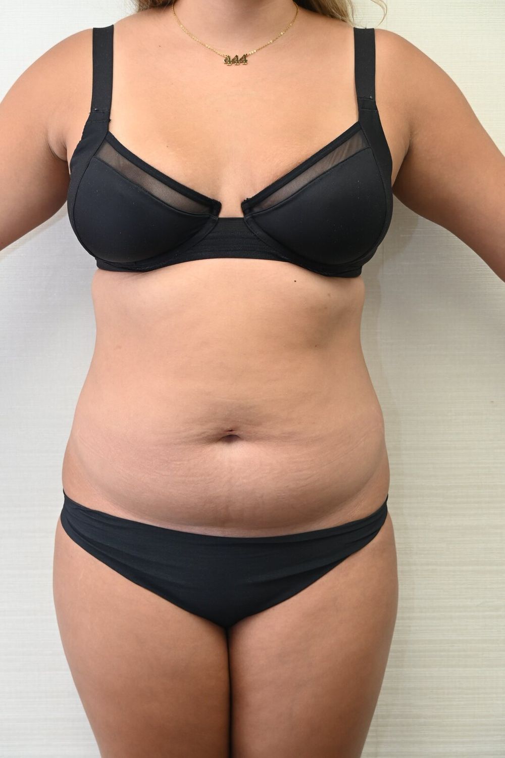Liposuccion Abdomen Before & After