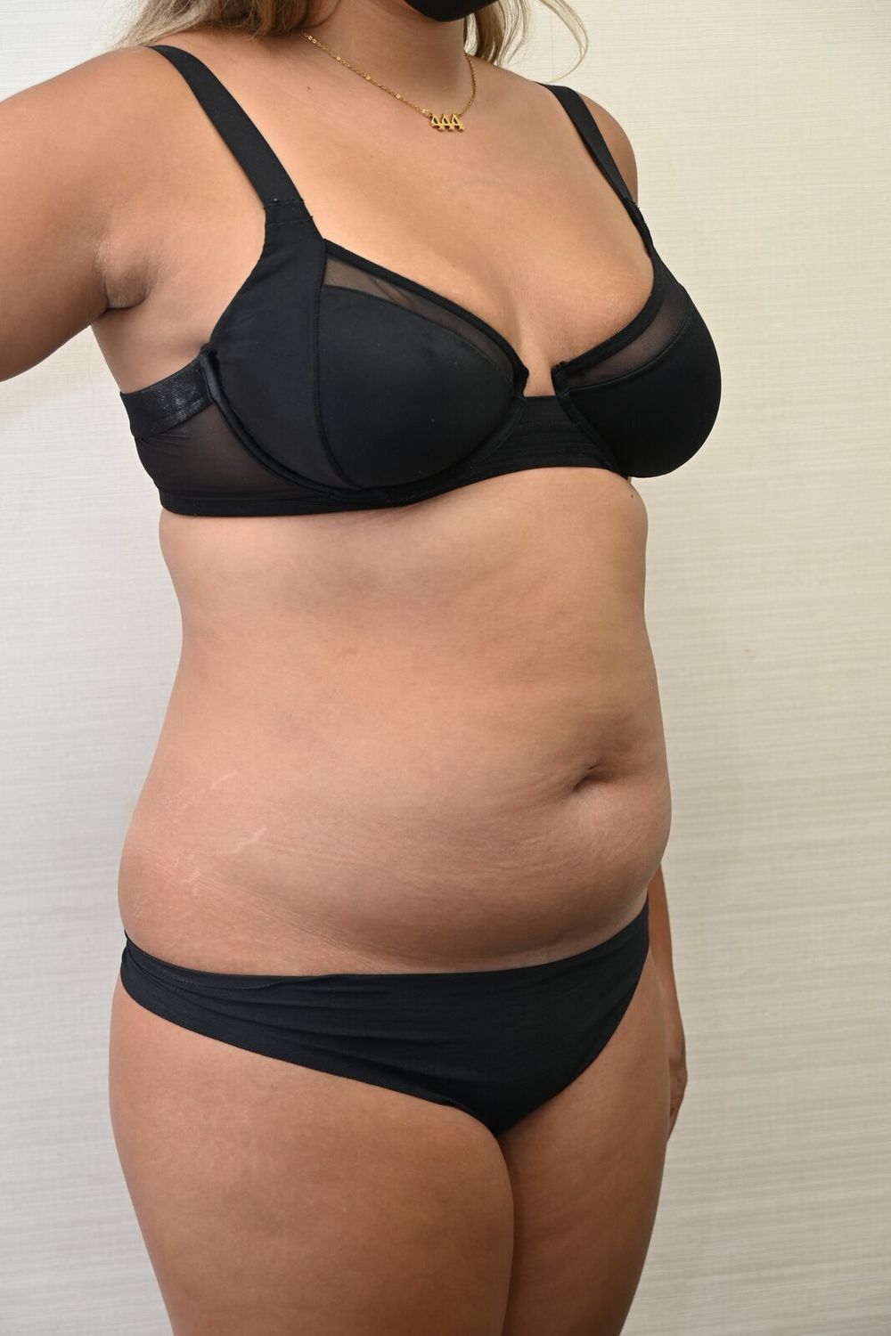 Liposuccion Abdomen Before & After