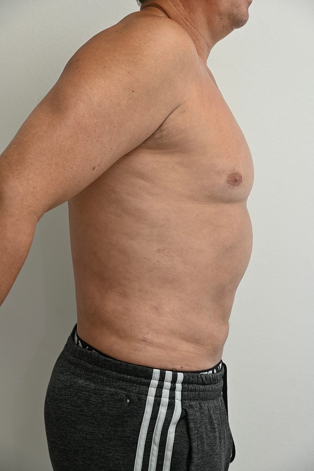 Liposuccion Abdomen Before & After