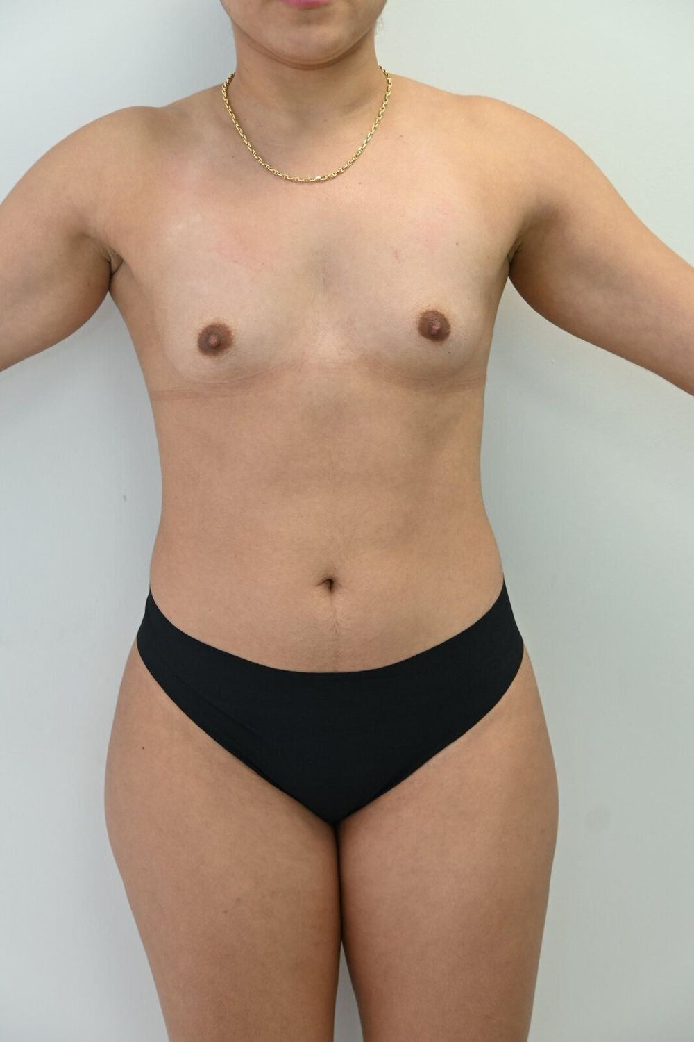Liposuccion Abdomen Before & After