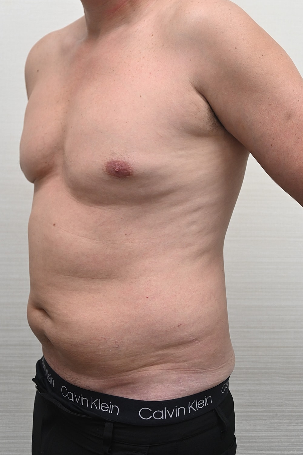 Liposuccion Abdomen Before & After