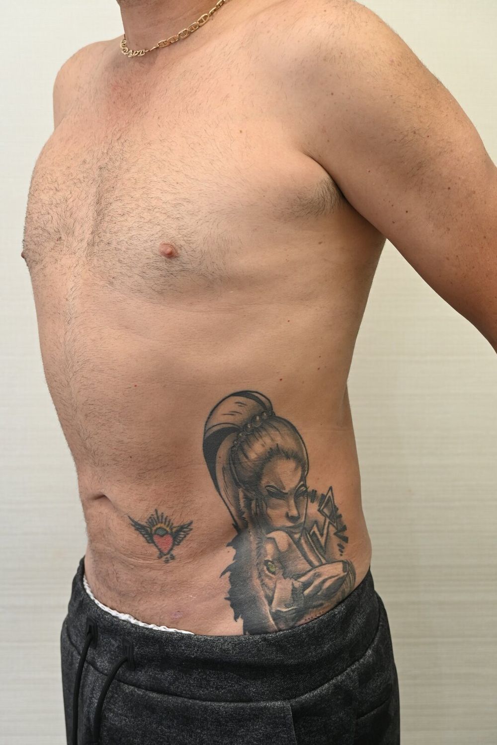 Liposuccion Abdomen Before & After