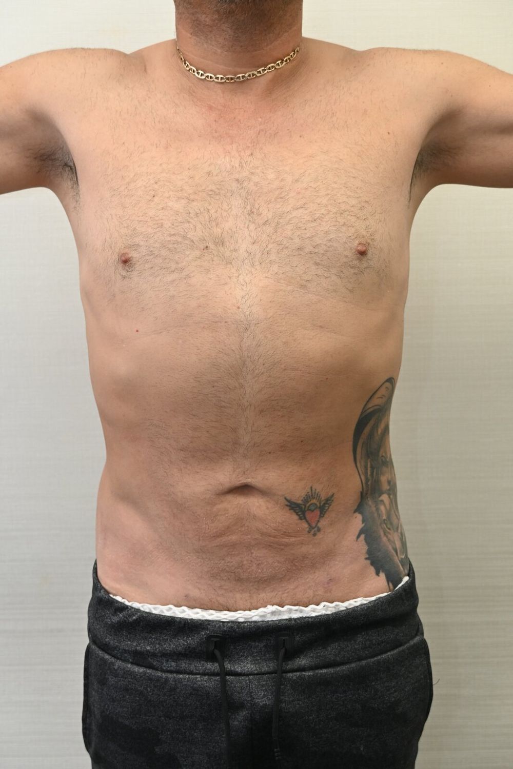 Liposuccion Abdomen Before & After