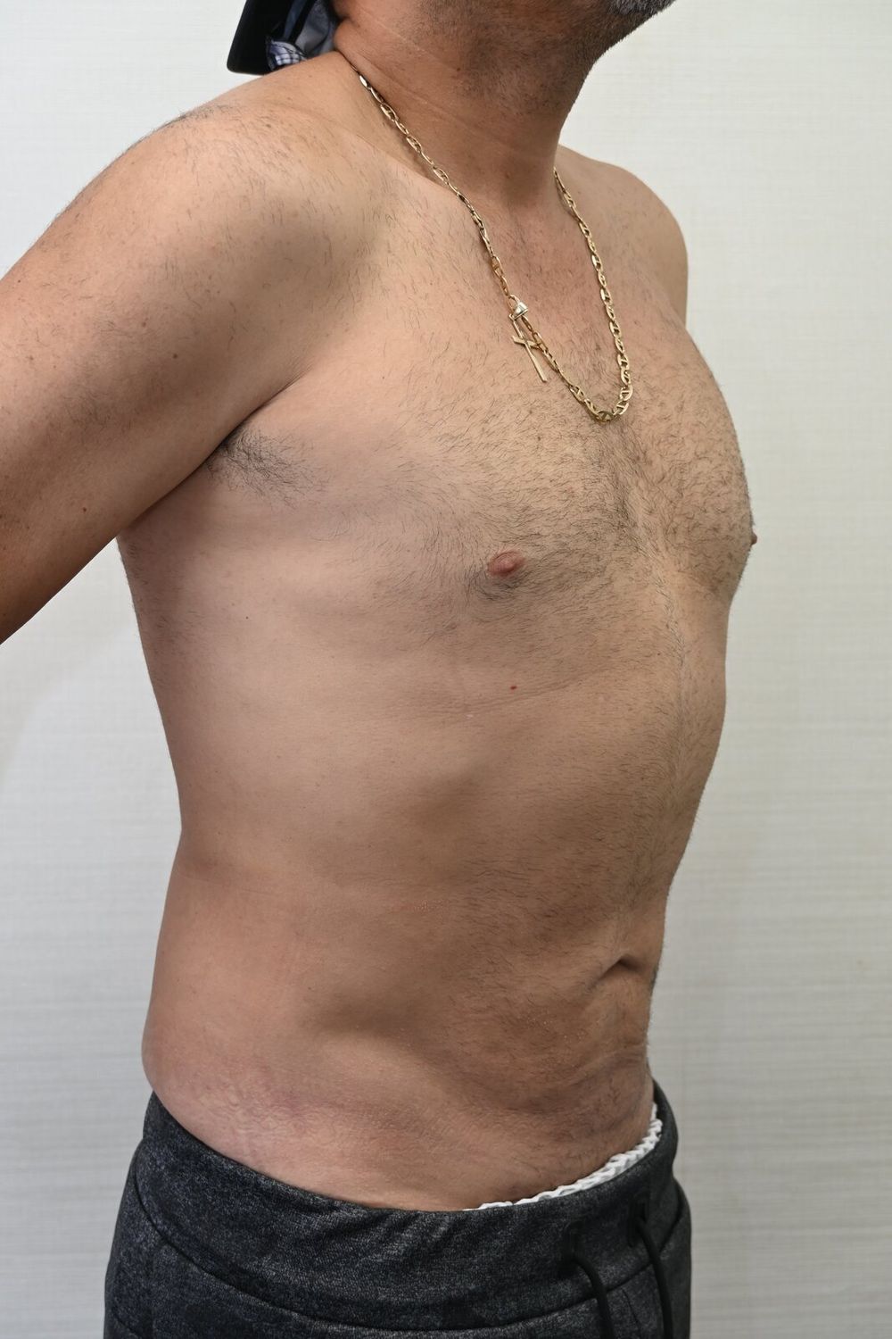 Liposuccion Abdomen Before & After
