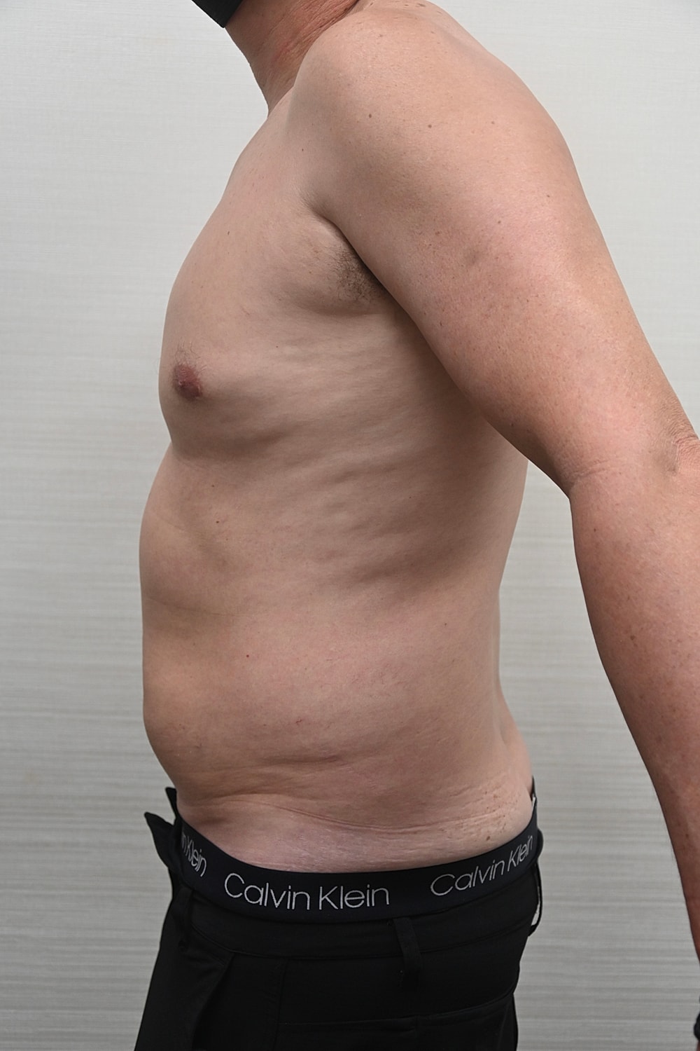 Liposuccion Abdomen Before & After