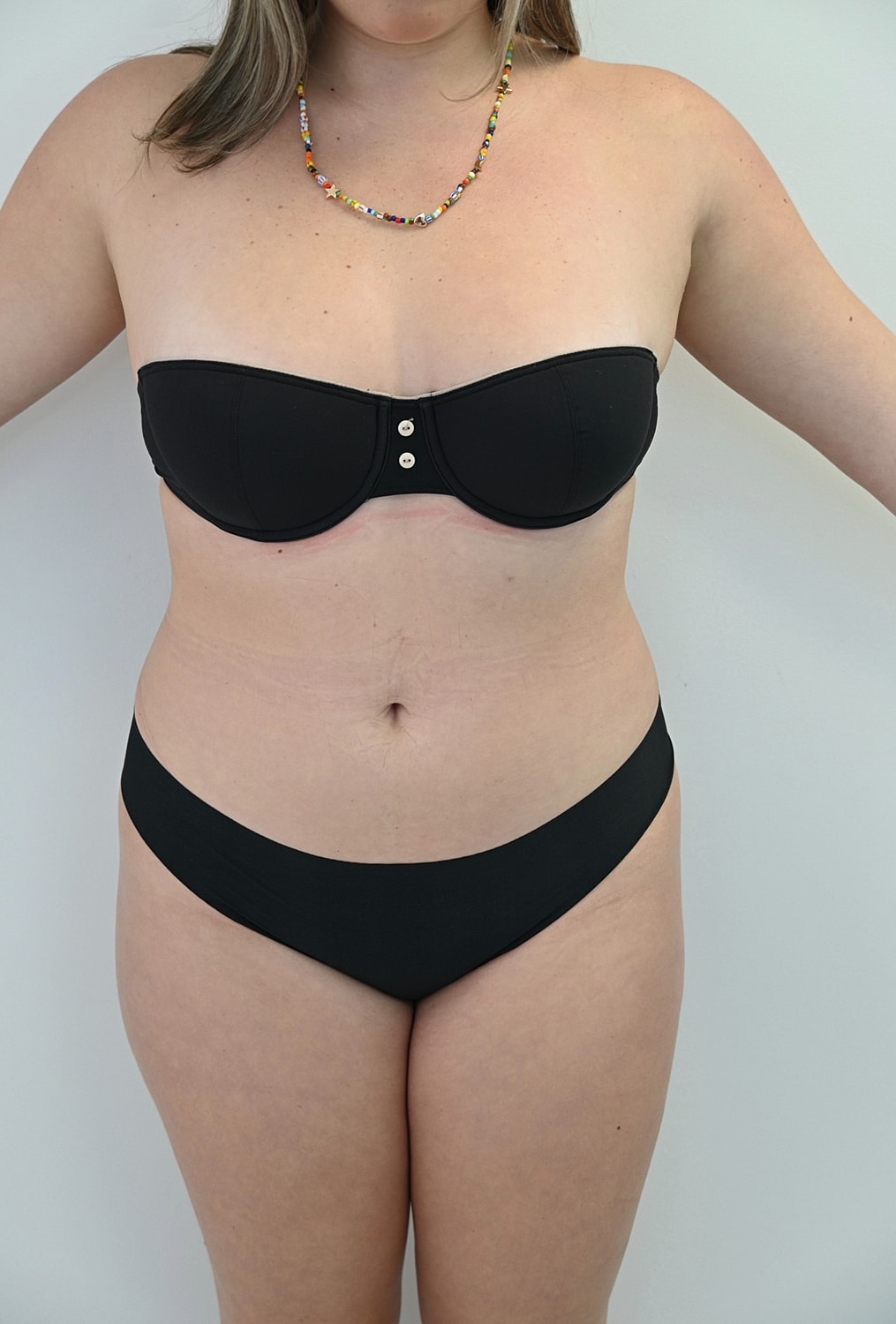 Liposuccion Abdomen Before & After