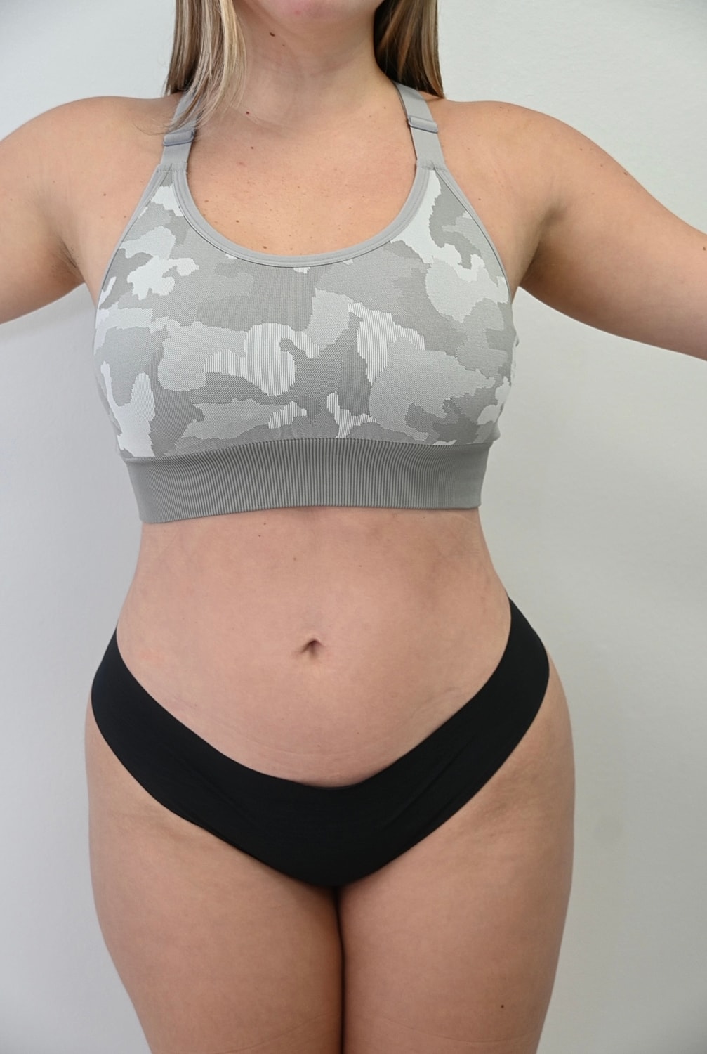 Liposuccion Abdomen Before & After