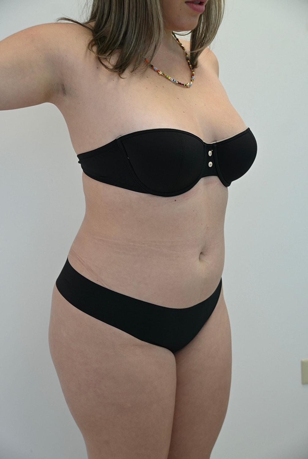 Liposuccion Abdomen Before & After